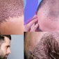 Türkiye'de Saç Ekimi - Hair Transplant in Turkey Nerede Yaptırılır?